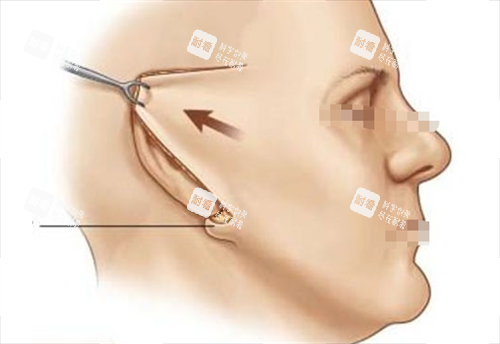 拉皮手術(shù)切口展示