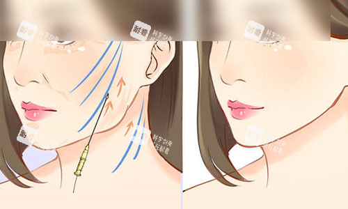 拉皮手術(shù)成效示意圖