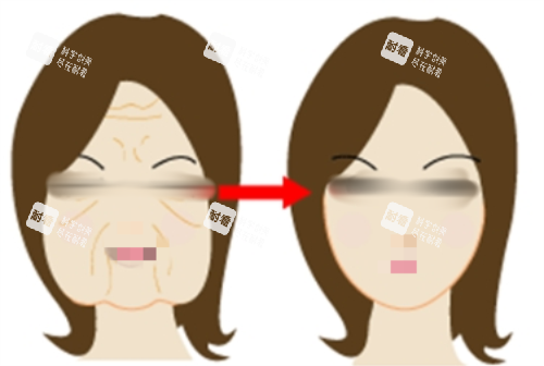 拉皮前后明顯對比圖