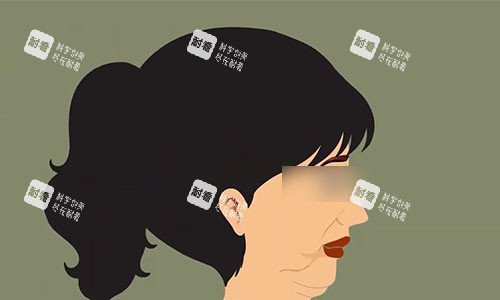 拉皮手術(shù)前的動畫示意圖