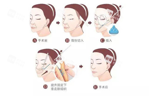 安多泰拉皮手術(shù)