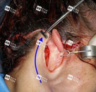 拉皮手術(shù)切口圖