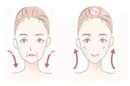 拉皮面部提升對(duì)比卡通示意圖
