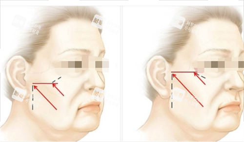 中上面部拉皮提拉方向畫線圖