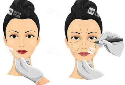 小拉皮手術(shù)過(guò)程