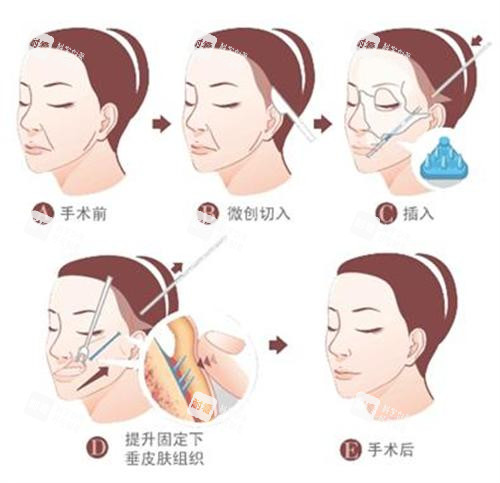 拉皮手術(shù)過(guò)程圖