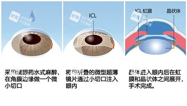 icl晶體植入手術方法