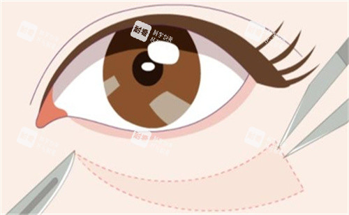 祛眼袋手術