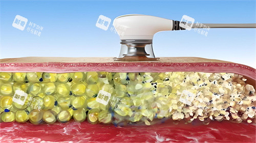 超聲波溶脂過程演示圖