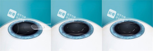 ICL晶體植入過程