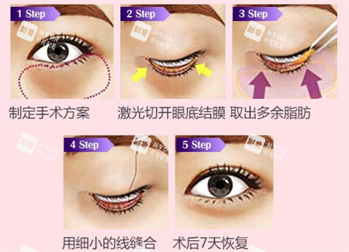 去眼袋手術(shù)過(guò)程