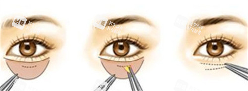 內(nèi)切法祛眼袋的手術(shù)步驟