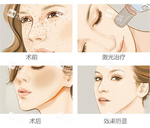 激光祛斑的過(guò)程