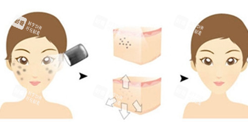 面部激光祛斑前后對(duì)比卡通示意圖