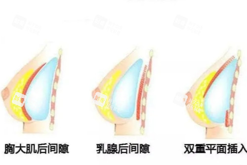 假體隆胸植入位置示意圖