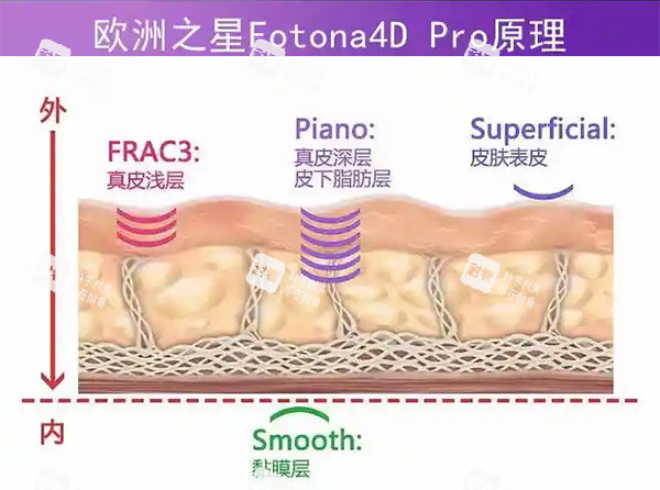 歐洲之星fotona4dpro原理示意圖