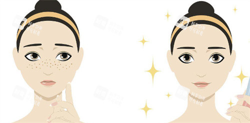 激光祛斑對比示圖