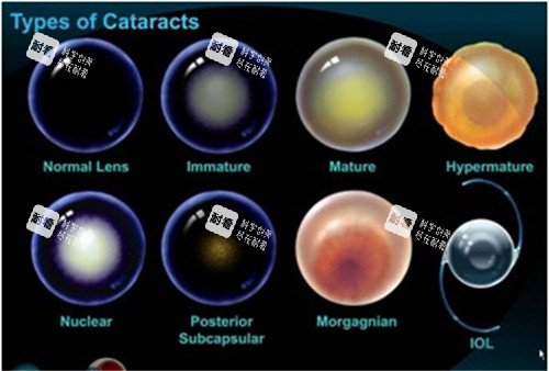 不同白內障晶體展示
