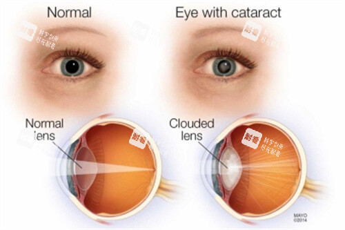 正常眼結構與白內障眼結構對比