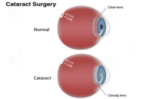 正常眼與白內障眼對比