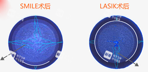 全飛秒和準分子激光手術(shù)術(shù)后漫畫圖