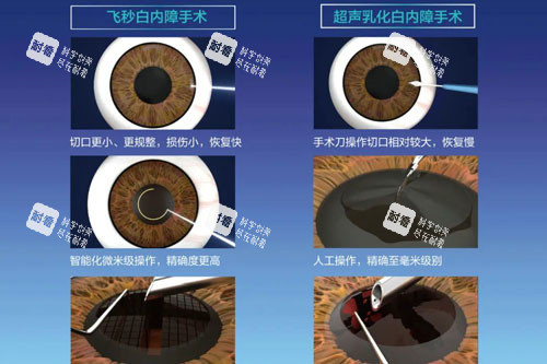 飛秒白內(nèi)障和超聲乳化白內(nèi)障