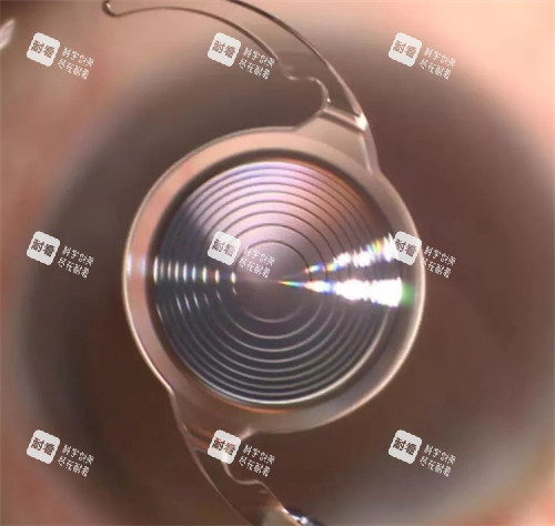 白內(nèi)障竟晶體示意圖