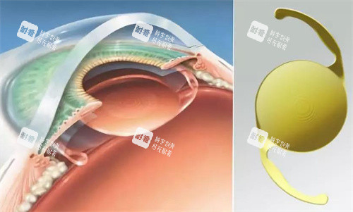 白內(nèi)障人工晶體的選擇