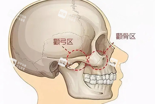 顴弓顴骨位置示意圖