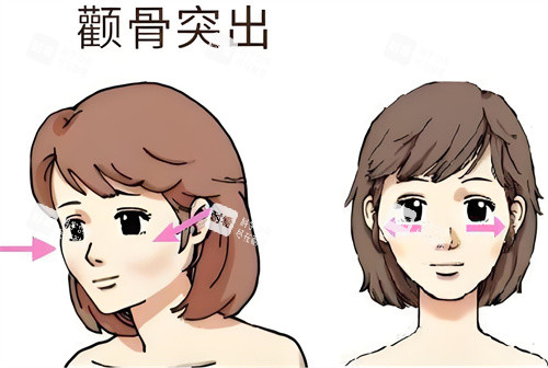 顴骨突出動畫演示圖