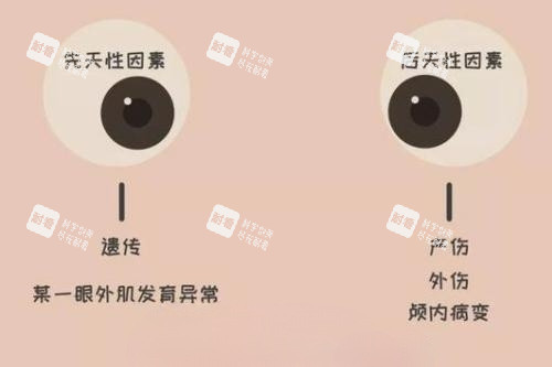 眼睛斜視產(chǎn)生原因卡通圖片
