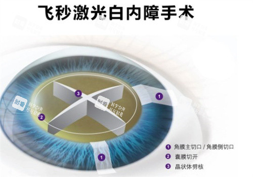 飛秒激光白內(nèi)障手術(shù)