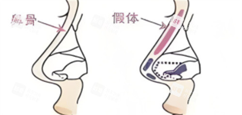 鼻綜合假體植入