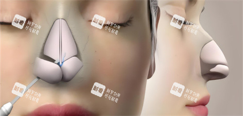 鼻綜合鼻骨動(dòng)畫(huà)