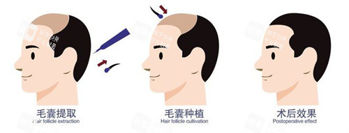 毛囊移植術(shù)前術(shù)后成效動畫圖