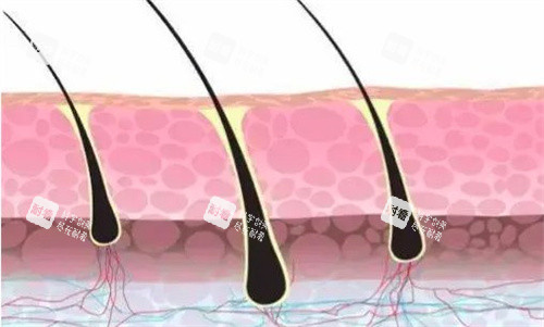 植發(fā)的毛囊