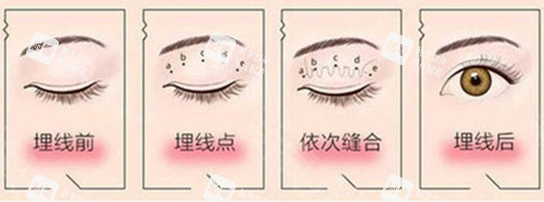 埋線雙眼皮過(guò)程示意圖片 埋線雙眼皮過(guò)程示意圖片