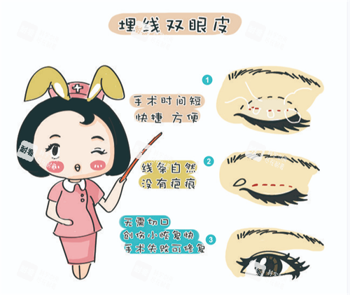 埋線雙眼皮 埋線雙眼皮