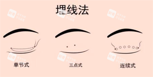 埋線雙眼皮經(jīng)過(guò) 埋線雙眼皮經(jīng)過(guò)