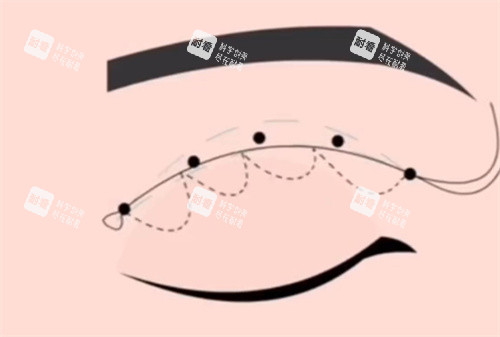 埋線雙眼皮 埋線雙眼皮