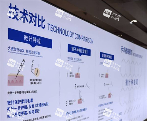 溫州大麥植發(fā)技術(shù)簡(jiǎn)介