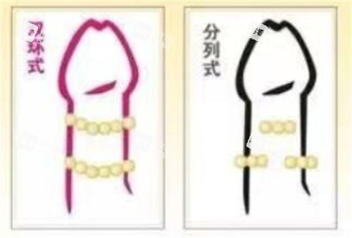 陰莖入珠術(shù)款式有哪些