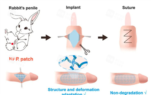 陰莖生物補(bǔ)片演示過程
