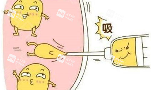 吸脂手術(shù)示意圖