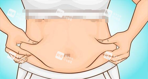 吸脂手術(shù)腹部脂肪堆積