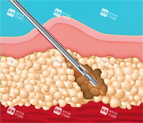 吸脂手術(shù)皮膚層