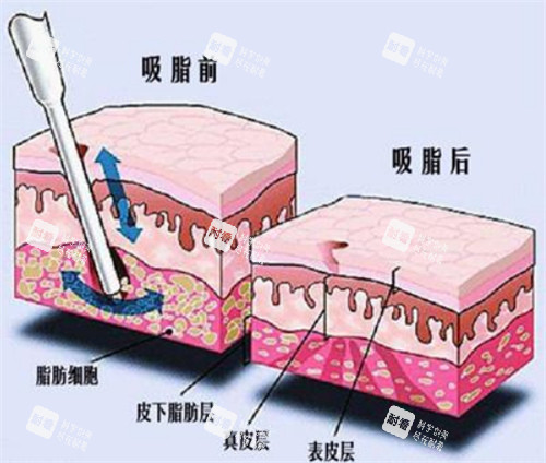 吸脂手術(shù)前后對(duì)比動(dòng)畫(huà)圖示