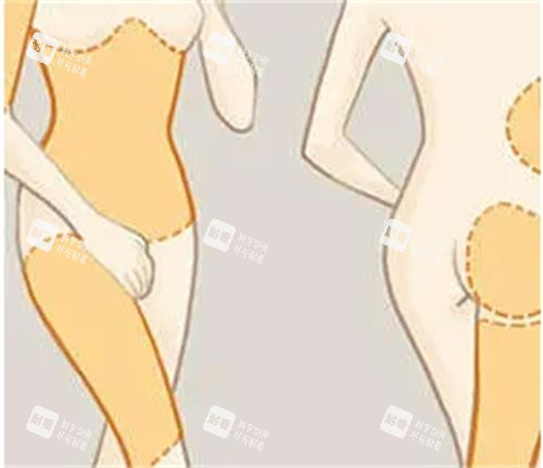 吸脂手術(shù)前后對(duì)比圖