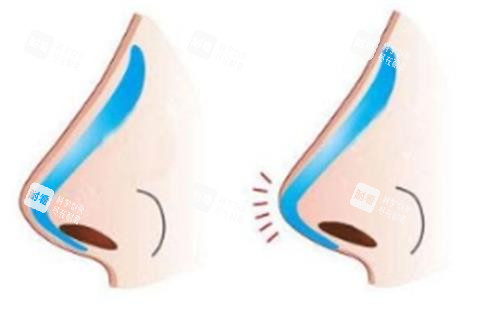 假體隆鼻示意圖