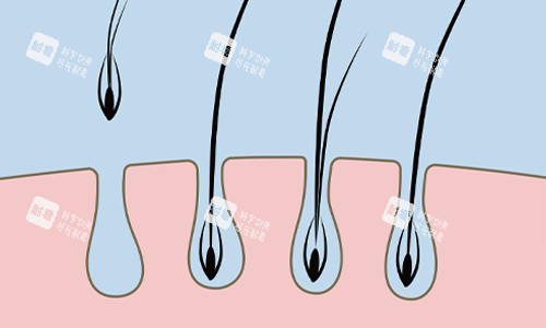 單毛囊植發(fā)展示